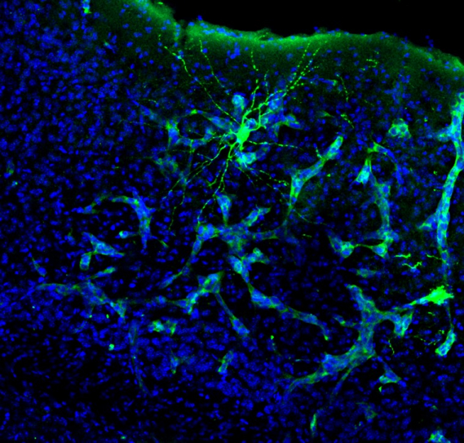 Metástasis en cerebro de ratón. Se aprecia cómo la metástasis (verde más claro) interacciona con una neurona (verde más intenso). Esta neurona está marcada específicamente para su estudio, pero la metástasis está interaccionando con muchas más