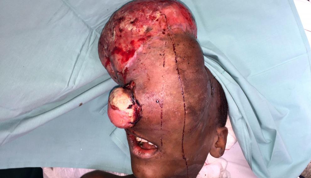 El pequeño, con el tumor en la cara antes de ser operado.