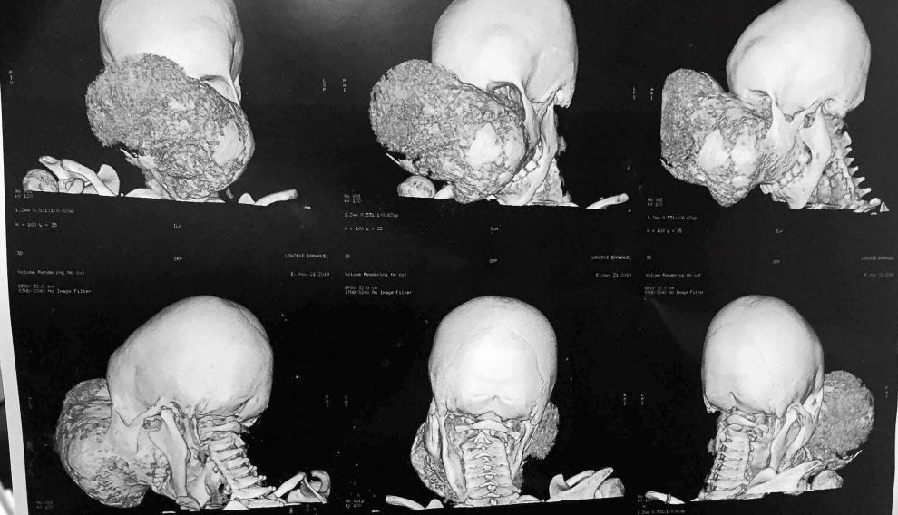 Radiografías del tumor.