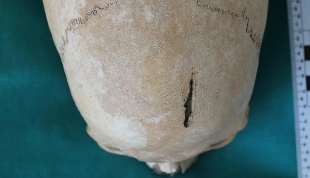 Imagen del cráneo con signos de trepanación encontrado en un solar zaragozano.