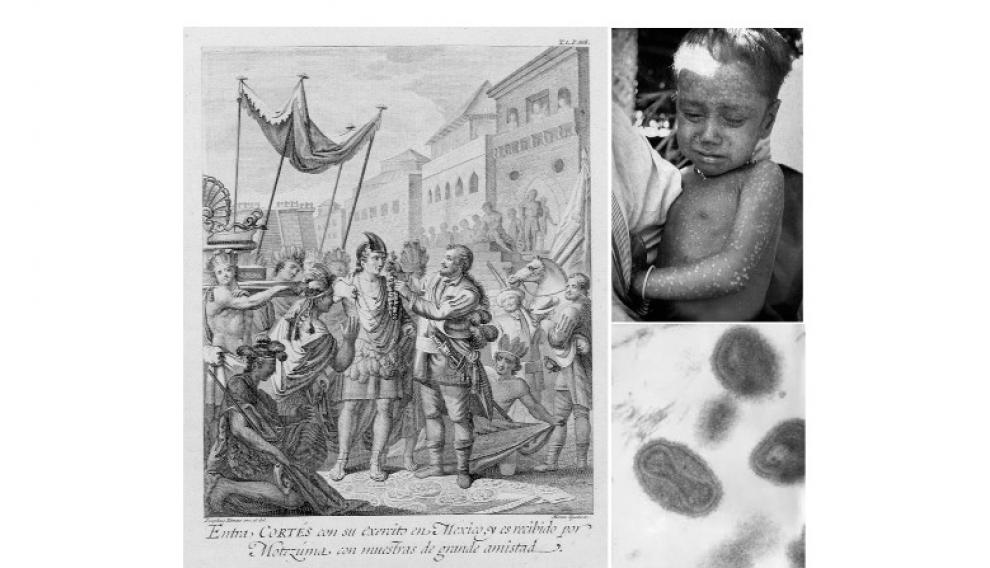 Grabado de Antonio de Solis y Rivadeneyra (1610-1686). Arriba a la derecha, niño infectado con el virus de la viruela. Debajo, virus de la viruela visto por microscopio electrónico