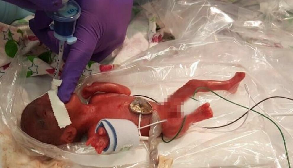 In this picture received by AFP from Sharp Mary Birch Hospital for Women & Newborns on May 29, 2019, shows baby Saybie, the world's smallest surviving newborn, when she was born in December 2018 in San Diego, California. - A baby girl who weighed 245 grams (8.6 oz) and measured 23 cm (9 inches) became the smallest baby in the world, a US hospital reported after being discharged five months after being in intensive care. (Photo by HO / various sources / AFP) / RESTRICTED TO EDITORIAL USE - MANDATORY CREDIT "AFP PHOTO / Sharp HealthCare/HO" - NO MARKETING NO ADVERTISING CAMPAIGNS - DISTRIBUTED AS A SERVICE TO CLIENTS US-health-infants