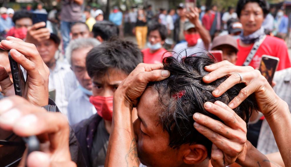 A man shows an injury after the police fired rubber bullets during protests against the military coup, in Mandalay