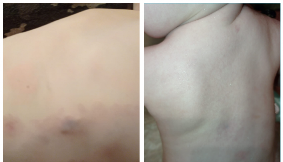 La heteroplasia provoca que cualquier pequeña mancha -a veces sin causa aparente como un golpe o un pinchazo- sea susceptible de convertirse en hueso.
