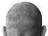 La alopecia es más común en hombres que en mujeres.