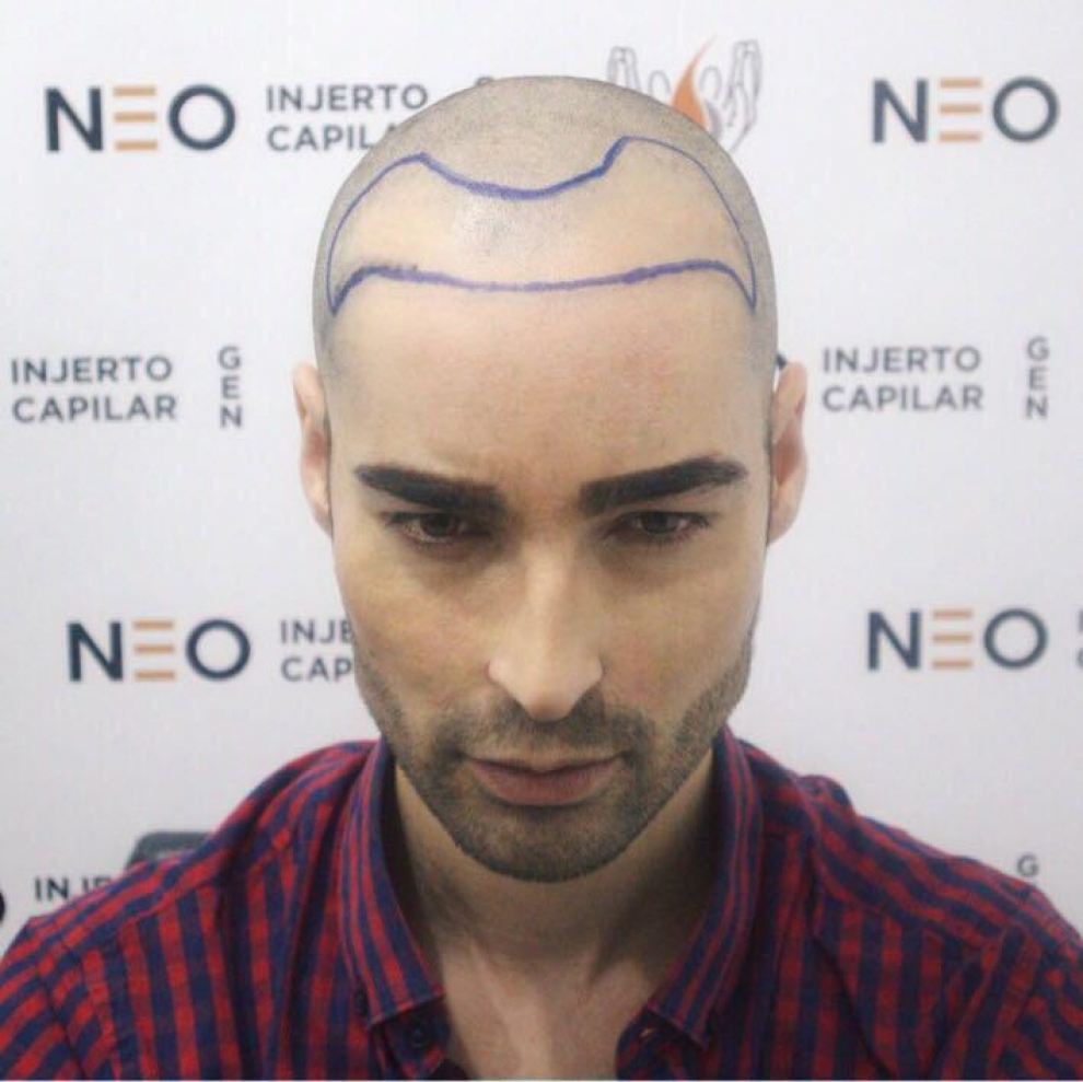 Miguel Vilas en el preoperatorio del injerto de pelo.