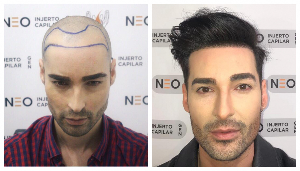Miguel Vilas, antes y después de realizarse el injerto capilar.