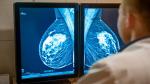 Los resultados del nuevo estudio cambian la práctica clínica en el cáncer de mama más frecuente y evitará la quimioterapia a miles de pacientes.