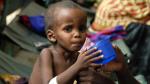 Un niño es atendido por sus problemas de salud en Somalia