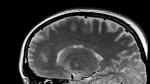 Resonancia magnética de un cerebro.