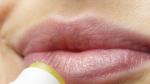 Unos de los más habituales suelen ser los herpes labiales