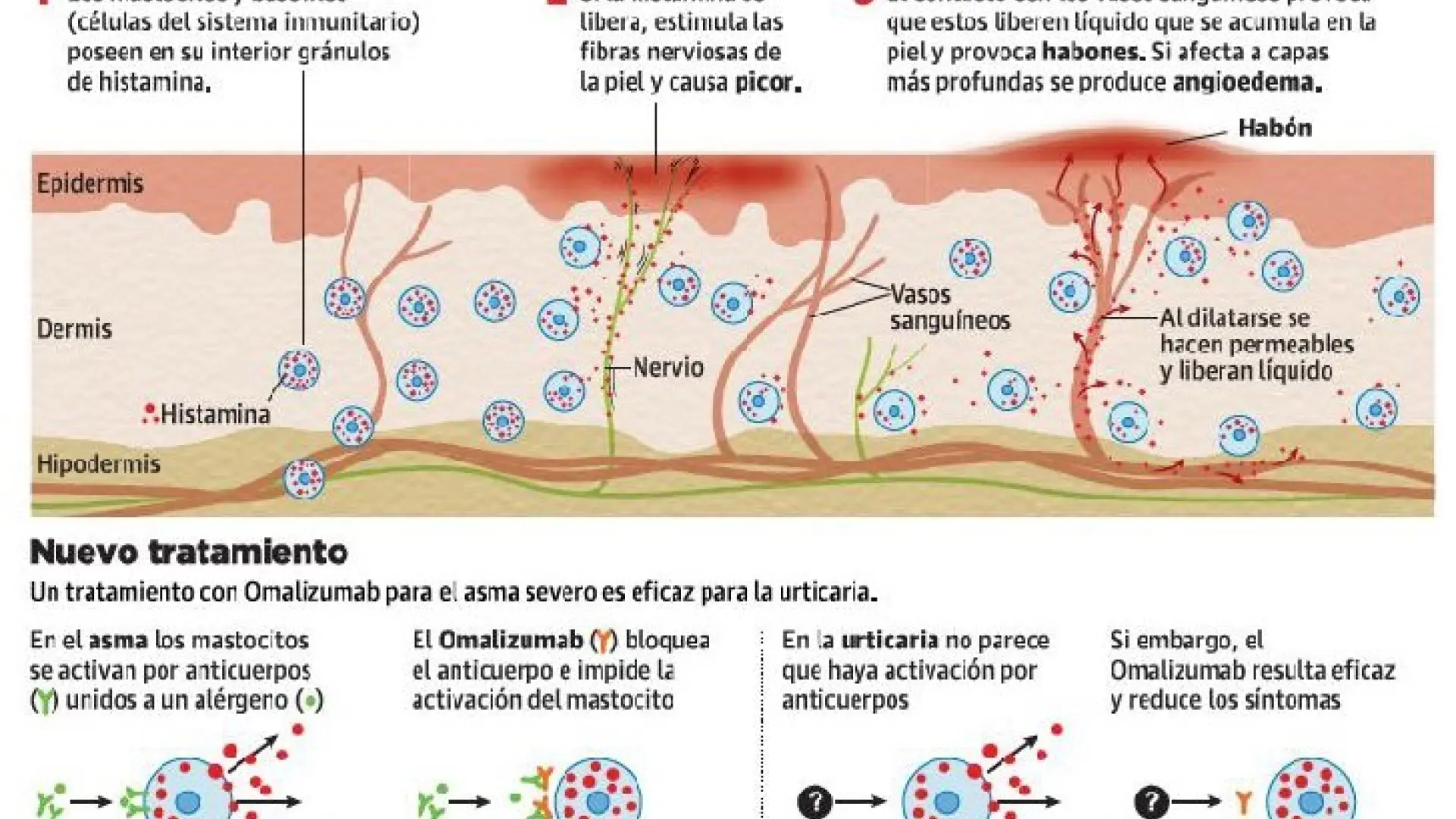 Urticaria De Estrés