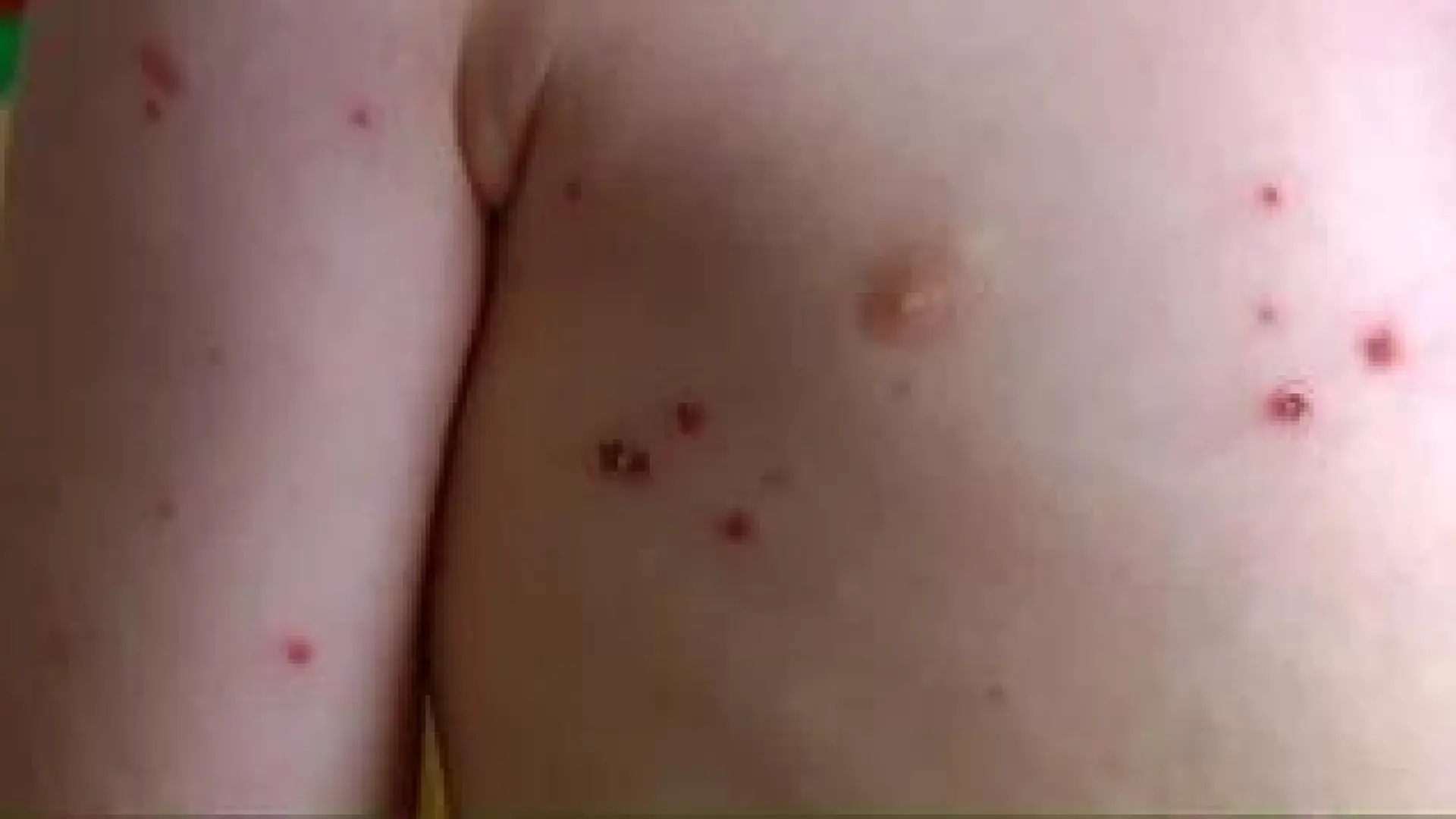 Cuáles son los síntomas del sarampión?