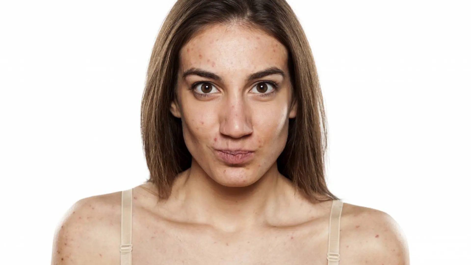 Tienes acné? Esto es todo lo que tienes que antes de tomar el sol