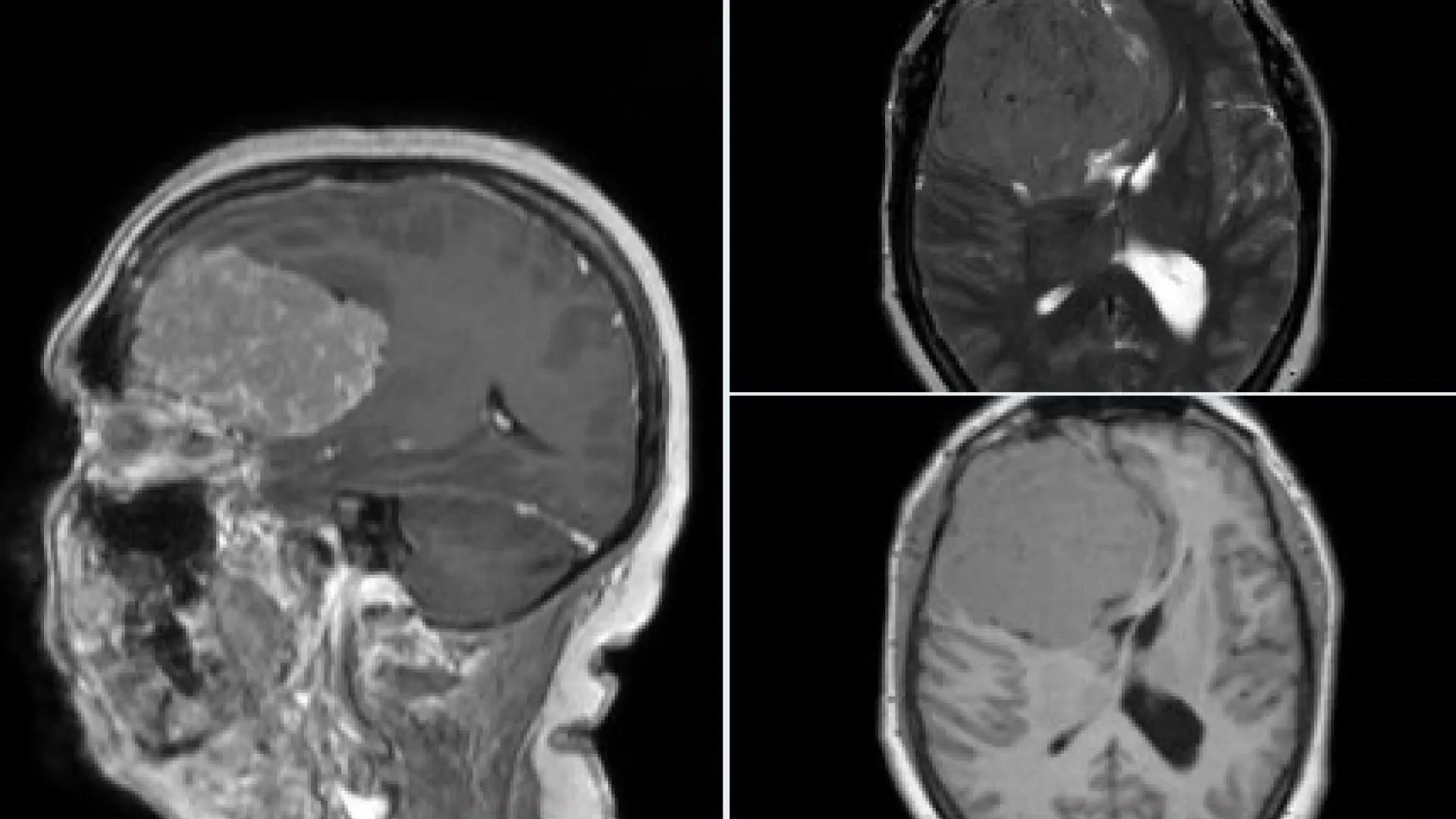 Una nueva prueba genética puede diagnosticar tumores cerebrales en tan solo dos horas