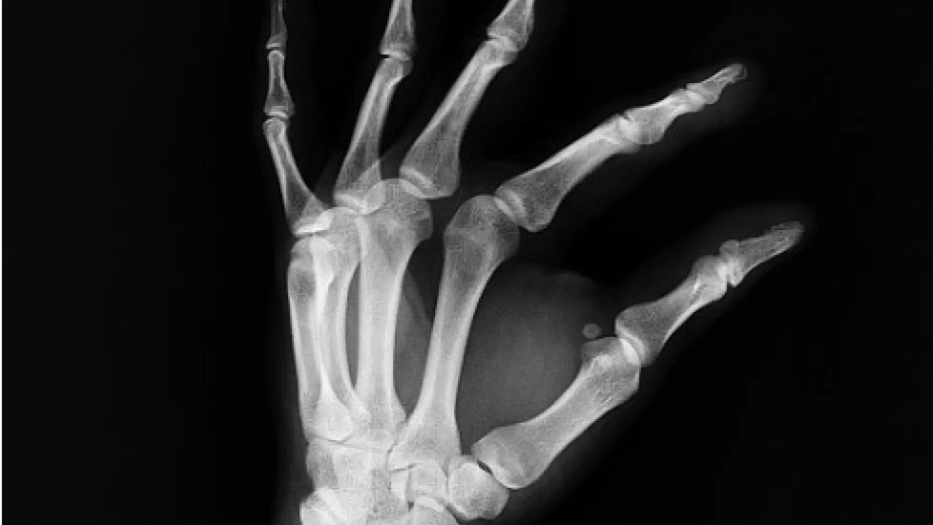 They’ve found a hormone that strengthens bones and could help treat bone problems