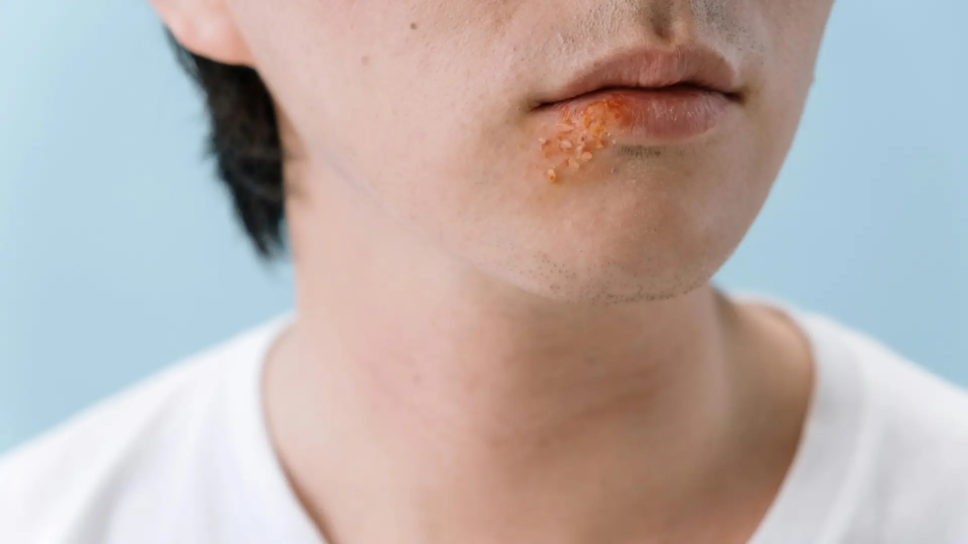 Un estudio asocia el herpes labial a más propensión a desarrollar alzhéimer