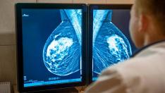 Algunas-mujeres-con-cancer-de-mama-podran-evitar-la-quimioterapia
