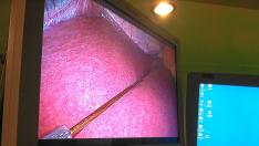 Imagen, durante una intervención de laparoscopia, en la que se observa un electrodo sobre el hígado para medir su gracia