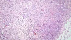 Tejido tumoral procedente de un ratón con cáncer de pulmón.