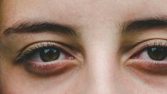 Tocarse los ojos en exceso puede provocar la aparición de ojeras.