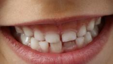 Los dientes definitivos comienzan a salir a los ocho años.