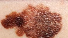 La genética y la exposición solar excesiva y repetitiva son factores que inciden en el desarrollo del melanoma, un tipo de cáncer de piel.