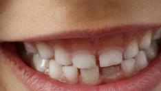 dientes niños