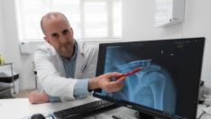 Lesiones en Traumatología por accidente de patinete.El traumatólogo Javier Muñoz enseña la radiografía de una fractura de tercio distal de clavícula, una de las más frecuentes en caso de accidente de patinete.
