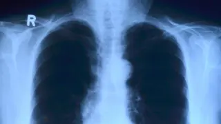 Radiografía de torax.
