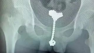 Radiografía del niño donde se observan 31 bolas magnéticas en el pene.