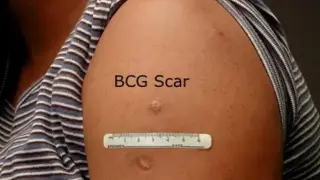 Diferencias entre la cicatriz que deja la vacuna de la tuberculosis BCG y la vacuna de la viruela.
