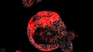 Células responsables de las recaídas del cáncer de colon