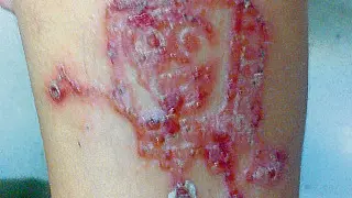 Imagen del brazo de un niño atendido en un centro de salud de Zaragoza con la reacción alérgica al tatuaje de henna. En esta foto, se ve perfectamente el dibujo de Bob Esponja.