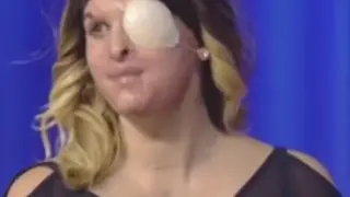 Gessica Notaro, miss italiana, muestra cómo ha quedado su cara después de que su exnovio le atacase con ácido.