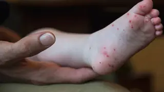 Este síndrome provoca la aparición de mpollas en manos, pies y nalgas.