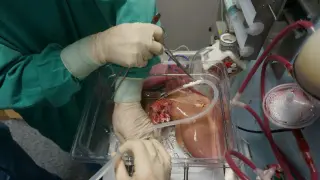 Un trasplante de hígado.