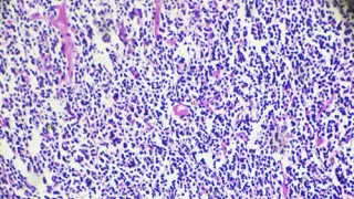 ¿Qué es el linfoma de Hodgkin?