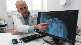 El traumatólogo Javier Muñoz enseña la radiografía de una fractura de tercio distal de clavícula, una de las más frecuentes en caso de accidente de patinete.
