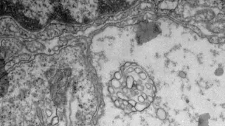 Una investigación aragonesa revela un nuevo mecanismo de comunicación entre células tumorales