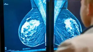 tipos de cancer de mama