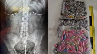 Combo de imágenes de una radiografía mostrando una bellota en el estómago y del total de droga incautada