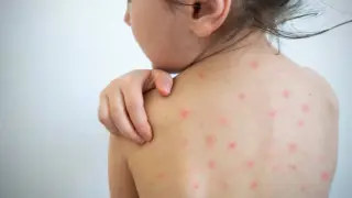 La erupción de la varicela se caracteriza por ampollas y el sarampión forma manchas que se extienden por el cuerpo.