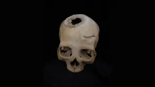 Imagen de un cráneo datado entre el 663 y el 343 a.C., y perteneciente a una mujer de más de 50 años con vestigios de haber sido trata de cáncer.