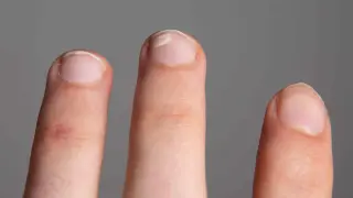 Manchas blancas en las uñas