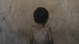 Yazan Abu Ful, a 2-year-old malnourished child, poses for a photo at his family home in the Shati refugee camp, in Gaza City on Wednesday, July 23, 2025. (AP Photo/Jehad Alshrafi)