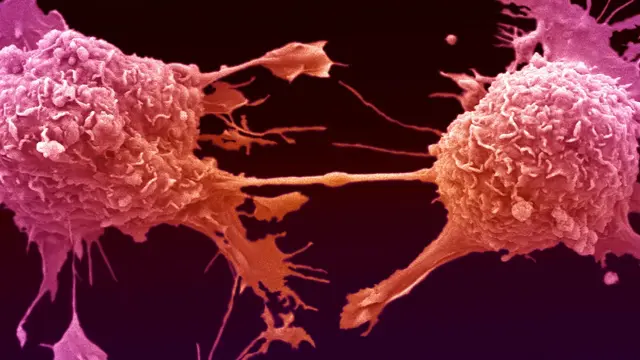 Células de cáncer de pulmón dividiéndose, unidas por un delgado hilo de citoplasma