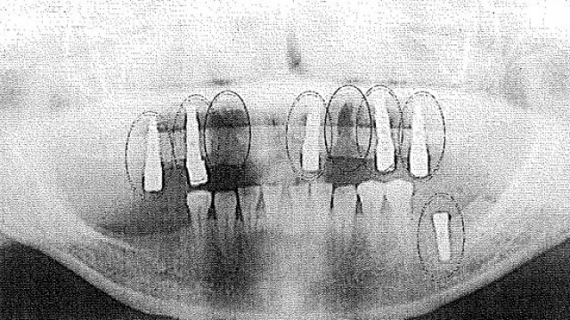 Radiografía de la boca de la paciente tras la colocación de los implantes defectuosos.