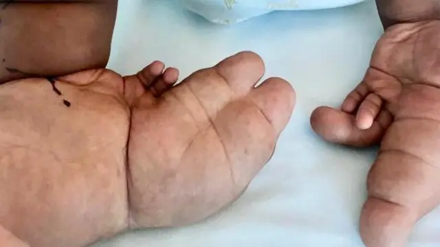 Las manos del niño de dos años que sufre Macrodistrofia Lipomatosa y fue intervenido en el Hospital Miguel Servet de Zaragoza.