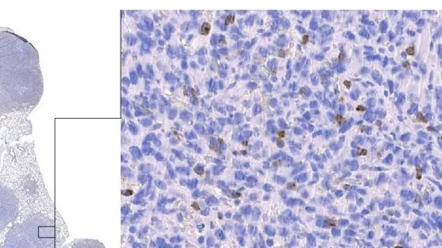 Linfocitos T citotóxicos (en marrón) infiltrados entre las células tumorales (en azul) de un modelo animal de cáncer de pulmón.